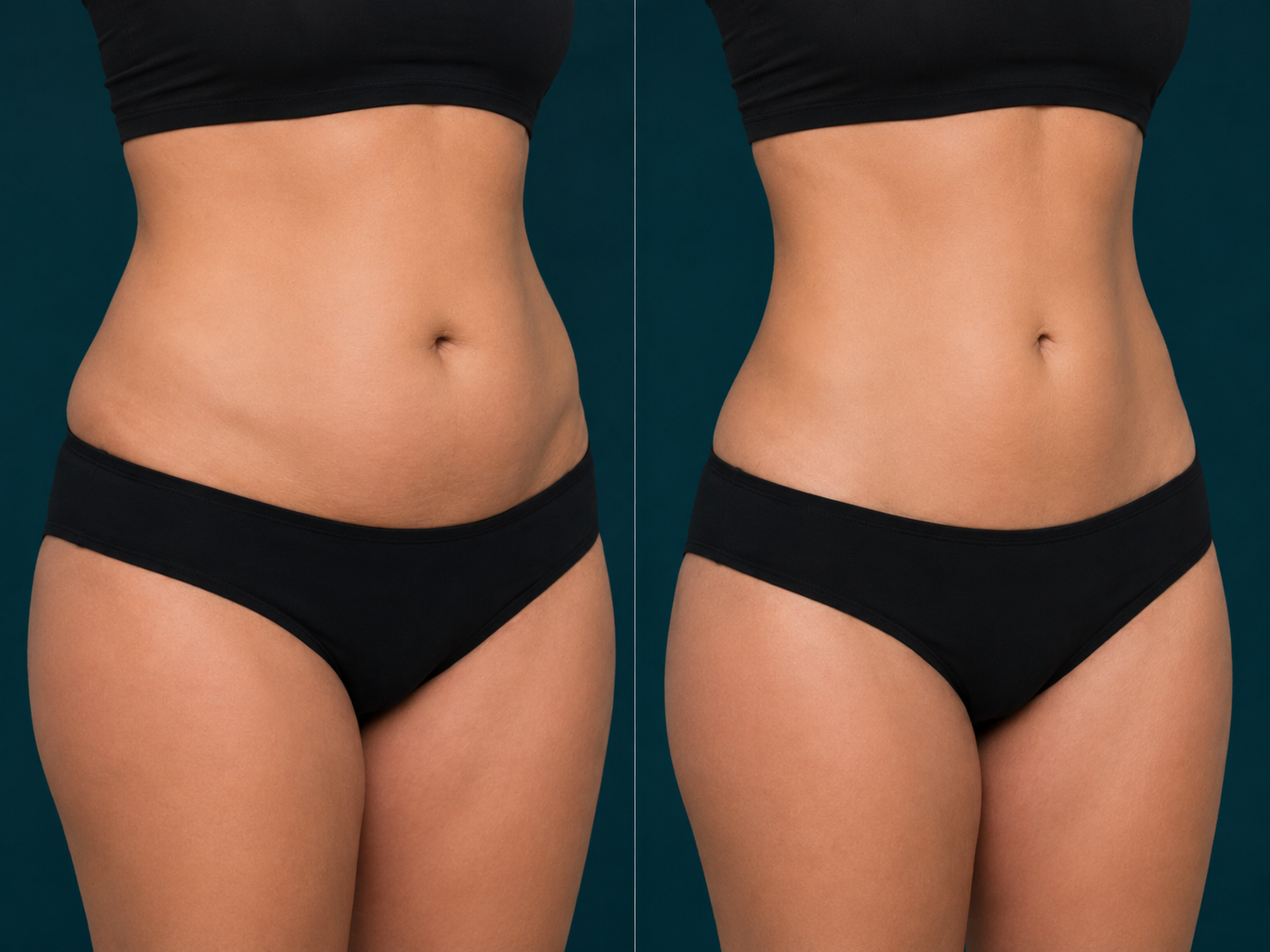 Liposuction before and after, abdomen, Rejuvenation Dermatology Calgary