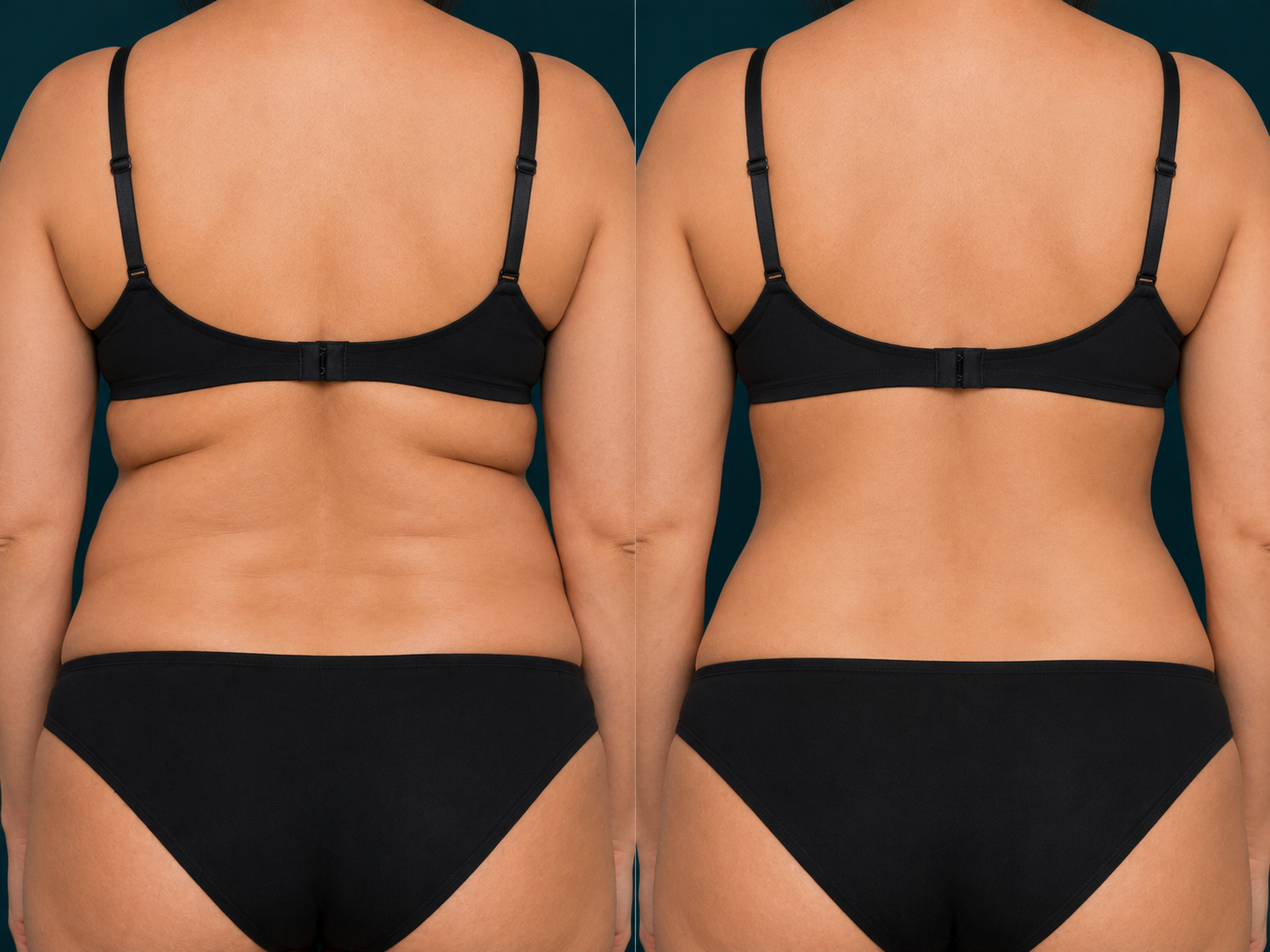 Liposuction before and after, flanks, Rejuvenation Dermatology Calgary