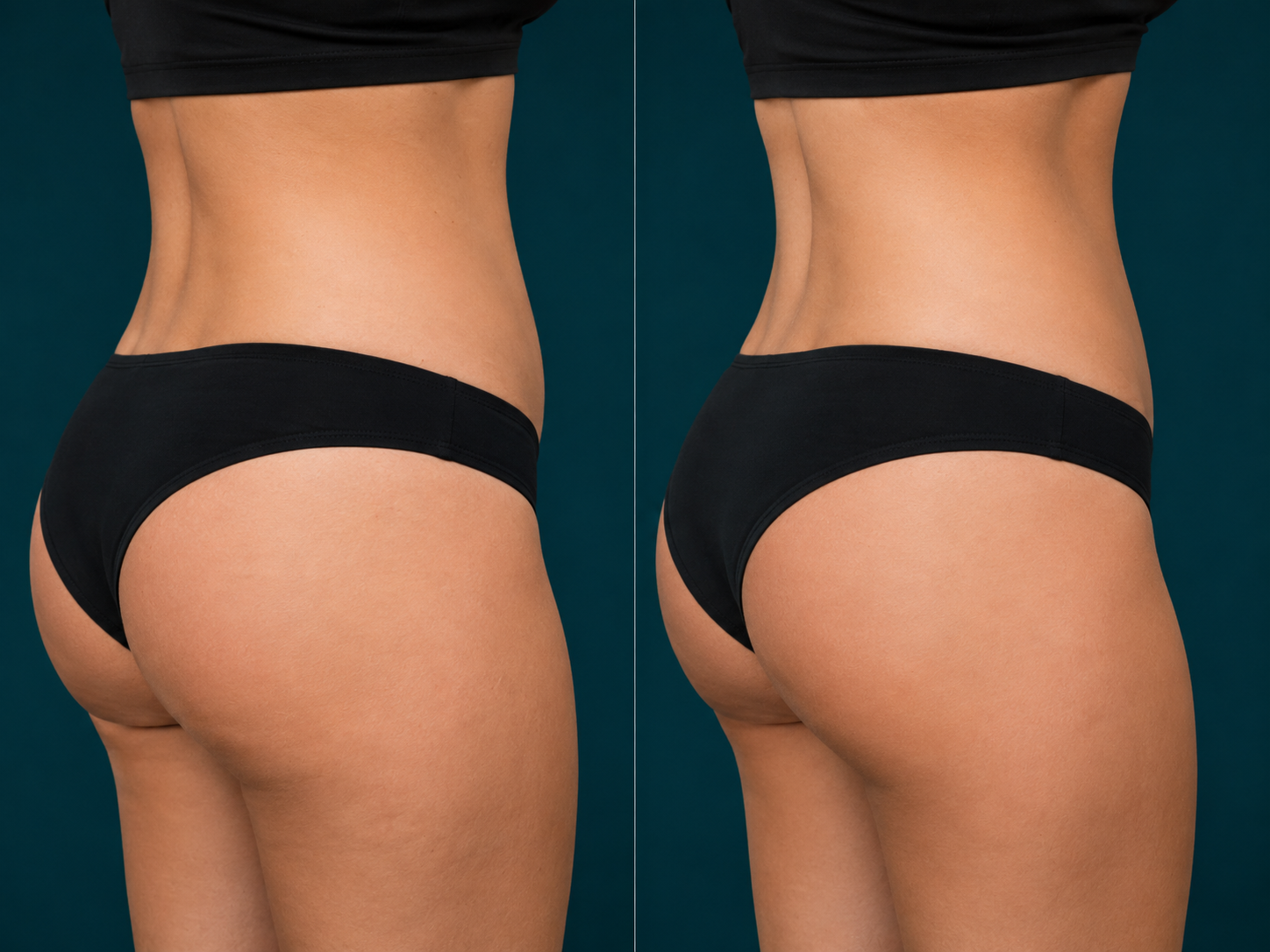 Liposuction before and after, back and bra line, Rejuvenation Dermatology Calgary