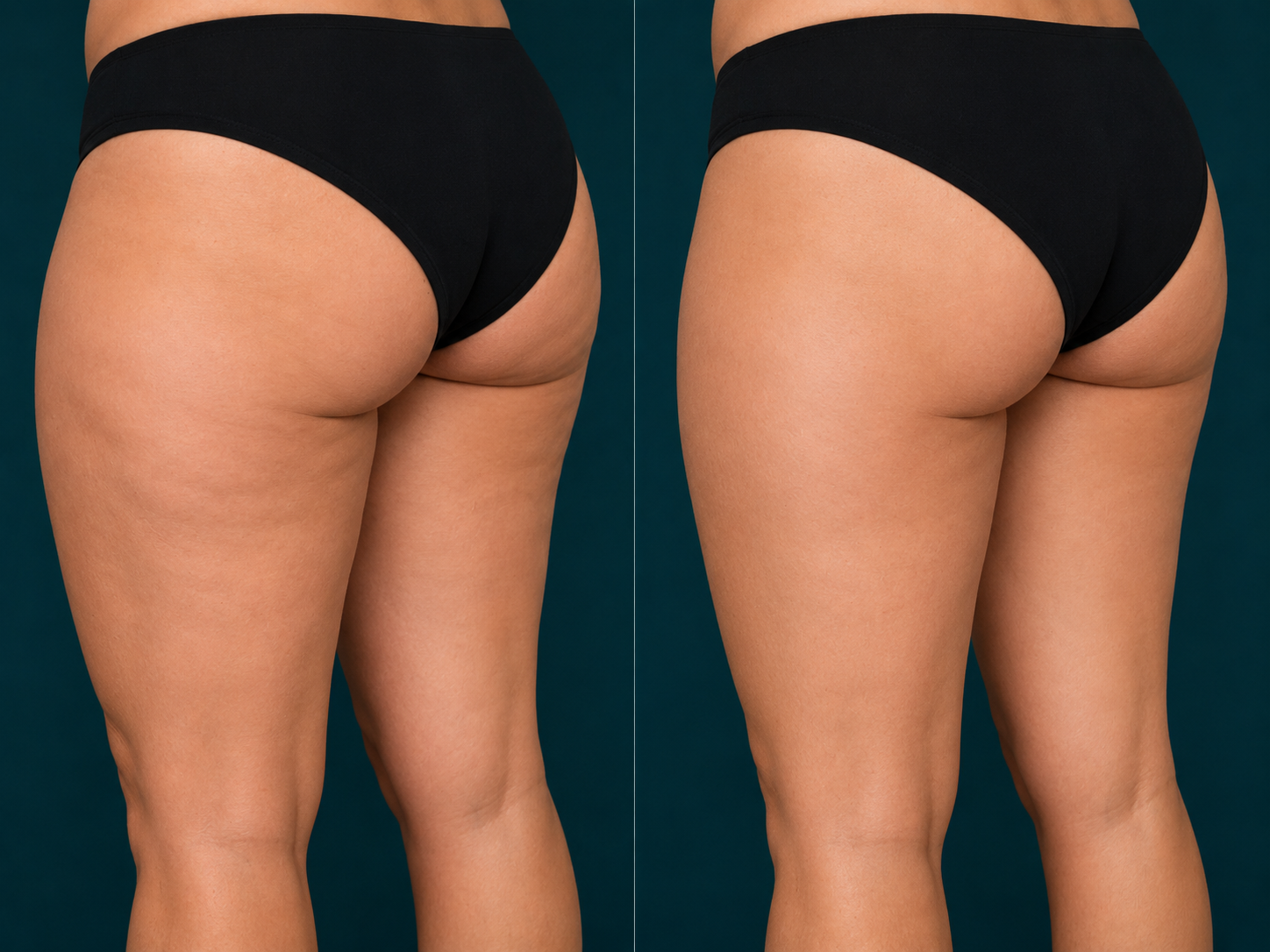 Liposuction before and after, outer thighs, Rejuvenation Dermatology Calgary