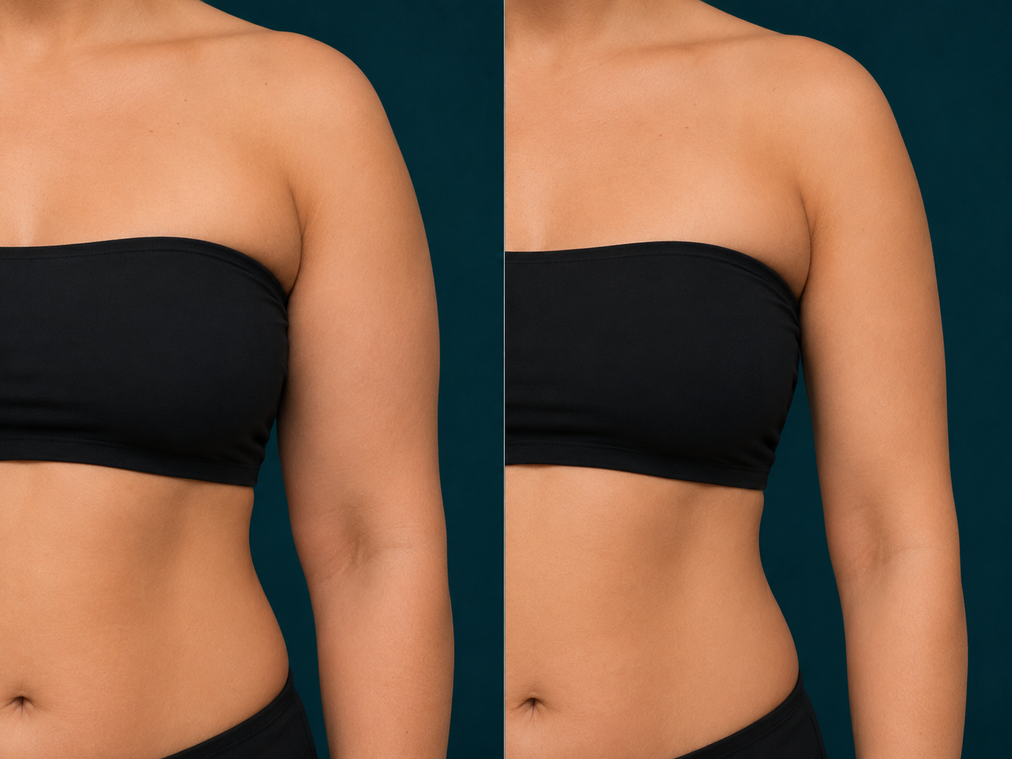 Liposuction before and after, upper arms, Rejuvenation Dermatology Calgary