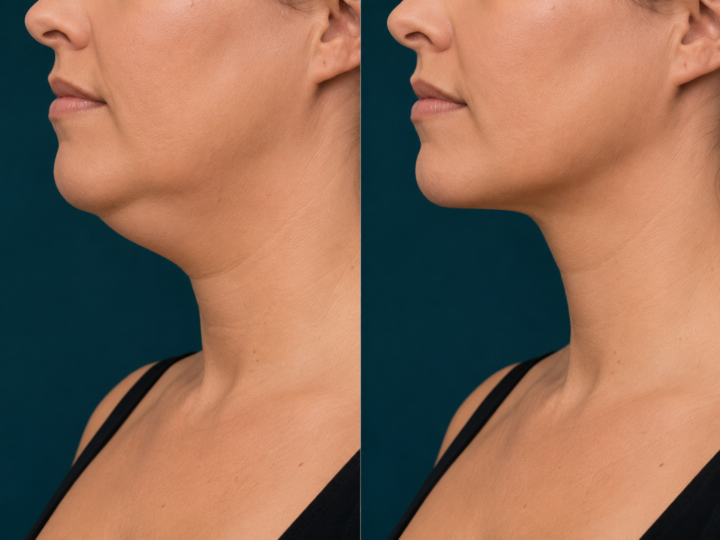 Liposuction before and after, chin and neck, Rejuvenation Dermatology Calgary