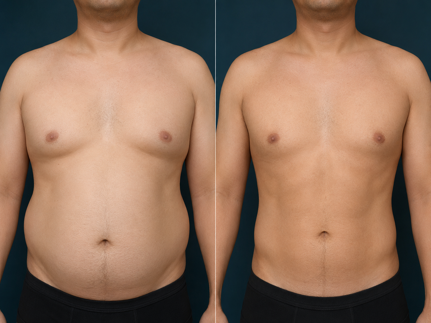 Liposuction before and after, abdomen and flanks, Rejuvenation Dermatology Calgary