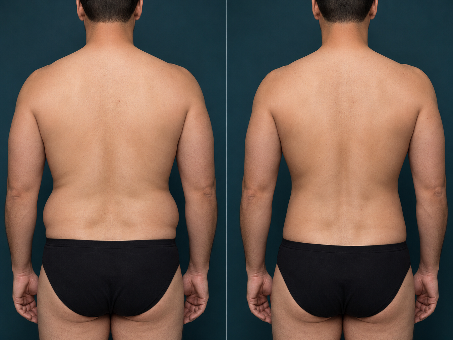 Liposuction before and after, hips and waist, Rejuvenation Dermatology Calgary
