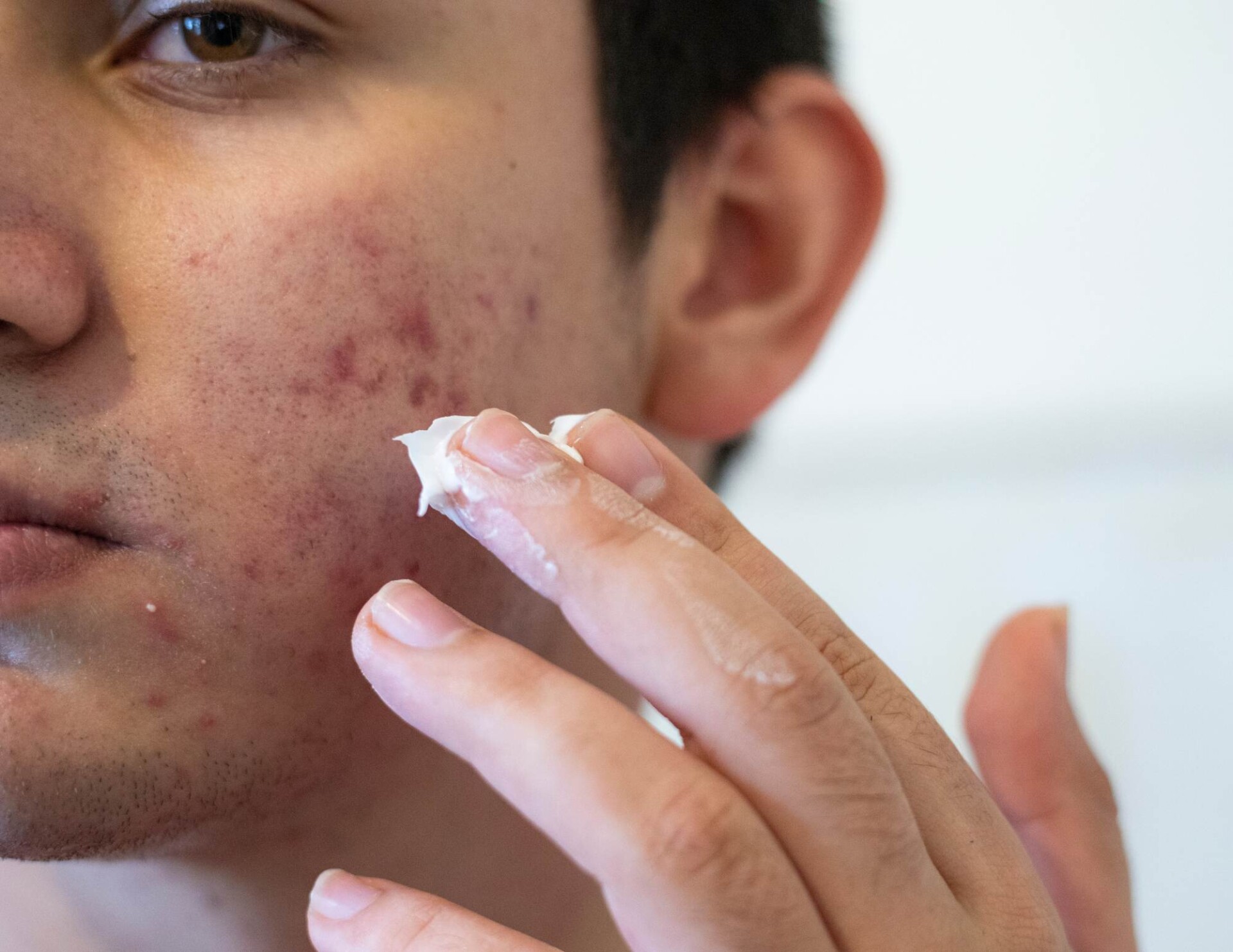 A close-up image of a person applying a cream to their cheek, which is affected by acne. The individual's skin shows redness and inflamed acne lesions. The person is using their fingers to apply the treatment, focusing on the affected areas.