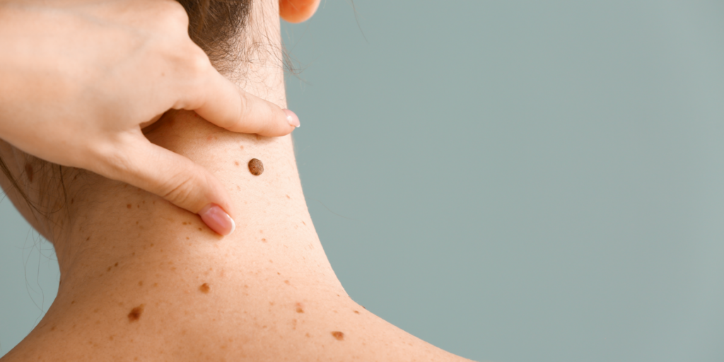 A close-up image of the back of a woman's neck showing numerous moles of various sizes and colours, highlighting the importance of regular skin examinations for melanoma prevention.