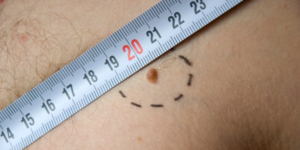Close-up image of a mole on skin with a ruler measuring diameter - an important part of the ABCDEs of melanoma.