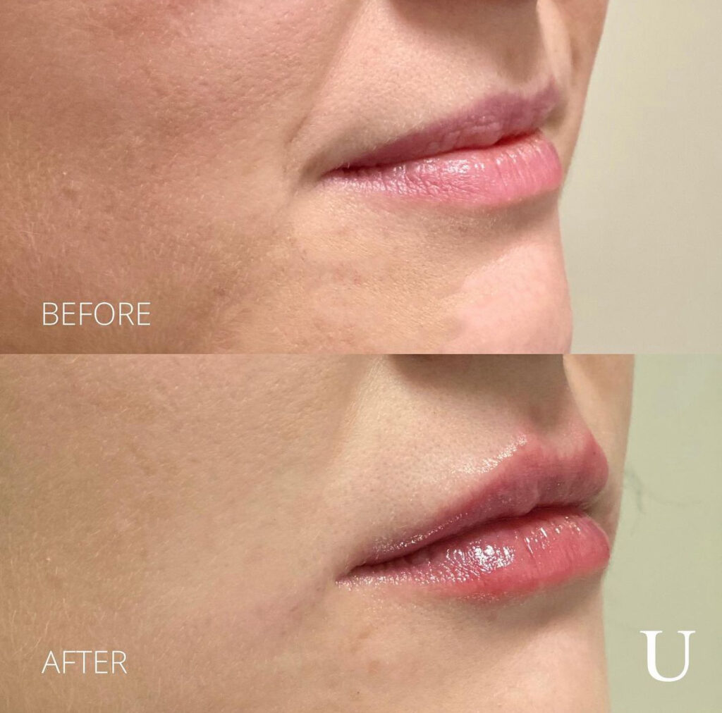 Side-by-side comparison of a woman's lips before and after receiving dermal fillers. The "before" image shows thinner, less defined lips with some fine lines. The "after" image shows fuller, more voluminous lips with a smoother and more hydrated appearance. The text "BEFORE" is labeled on the top image, and "AFTER" is labeled on the bottom image, with a small "U" logo in the lower right corner.