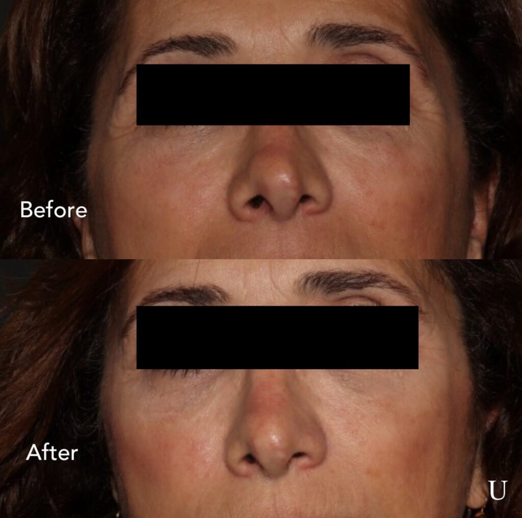 Side-by-side comparison of a woman's nose before and after receiving dermal fillers. The "before" image shows the nose with uneven contours and minor imperfections. The "after" image shows a more defined and smoother nose shape with improved symmetry. The woman's eyes are covered with black bars for privacy. The text "Before" is labeled on the top image, and "After" is labeled on the bottom image, with a small "U" logo in the lower right corner.
