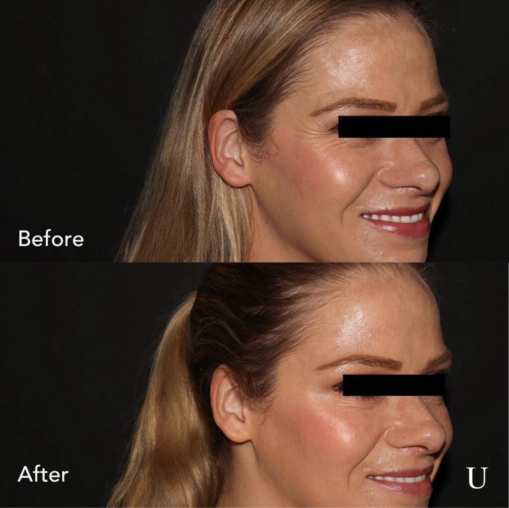 Side-by-side comparison of a woman's face before and after receiving Botox® injections. The "before" image shows the woman smiling with visible crow's feet around her eyes. The "after" image shows a noticeable reduction in crow's feet, resulting in smoother skin and a more youthful appearance. The woman's eyes are covered with black bars for privacy. The text "Before" is labeled on the top image, and "After" is labeled on the bottom image, with a small "U" logo in the lower right corner.
