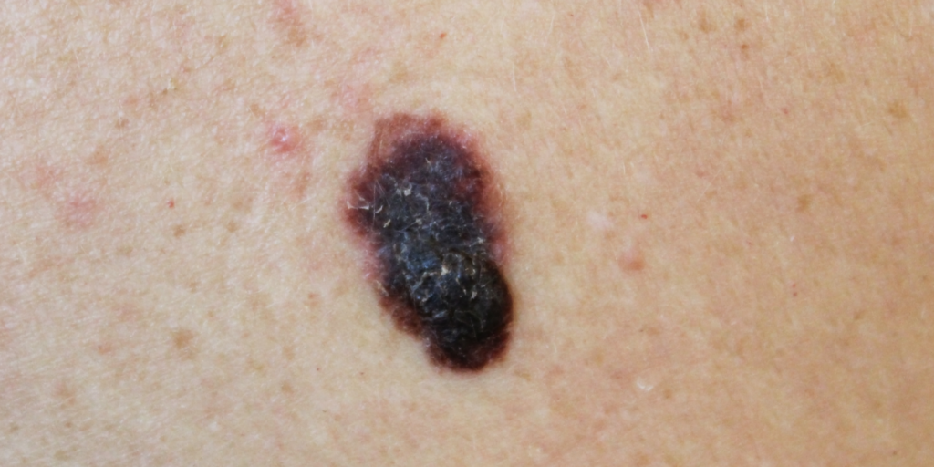 Close-up image of a melanoma mole on skin, highlighting the importance of regular skin examinations for early detection and prevention.